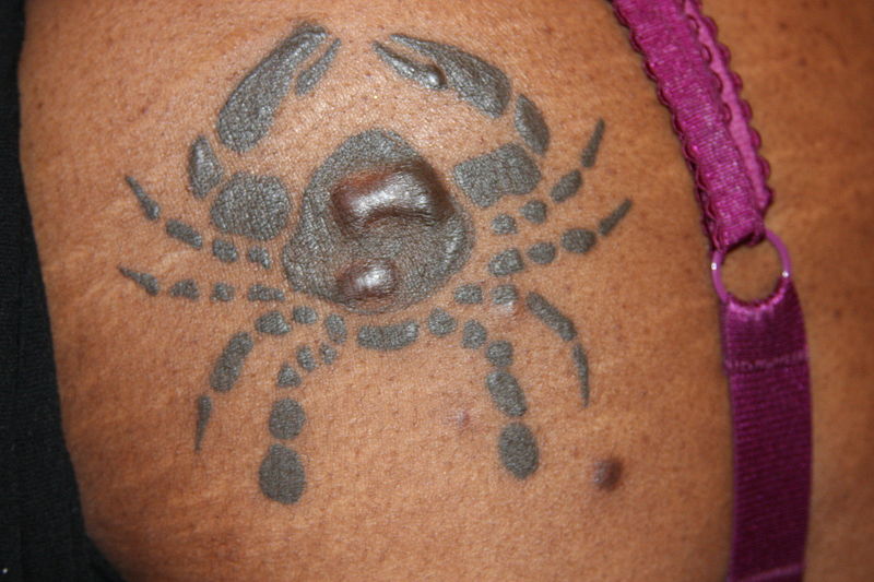 Tattoo diseases